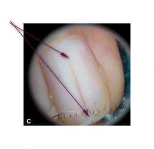 Рис. 3. Отслойка и расщепление ногтевой пластины при эритронихии. Дерматоскопия
