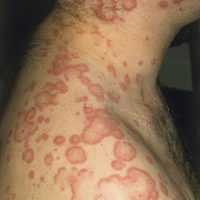 Лямблиоз - проявления на коже