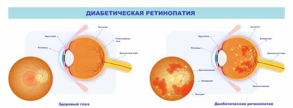 Ретинопатия.jpg