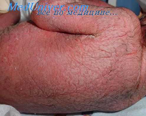 септический шок