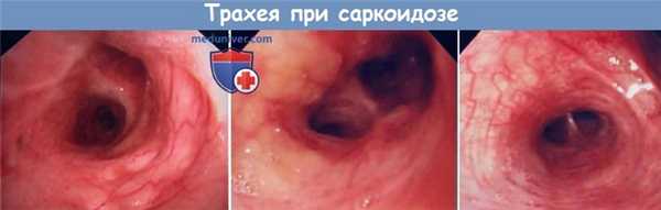Трахея при саркоидозе
