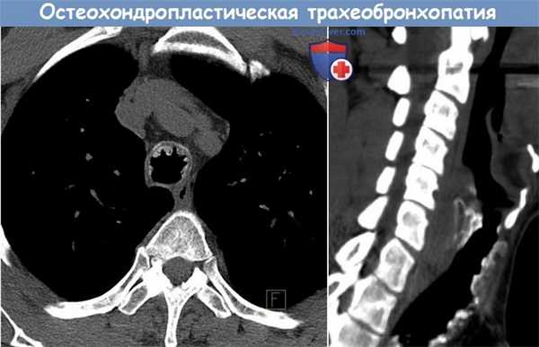 Остеохондропластическая трахеобронхопатия
