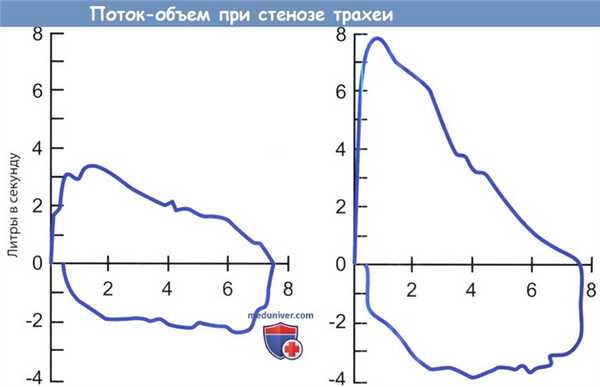 Петля поток-объем при стенозе трахеи