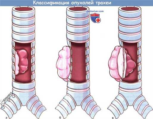 Классификация опухолей трахеи