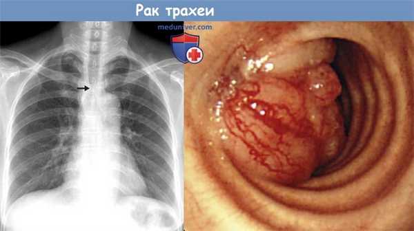 Рак трахеи