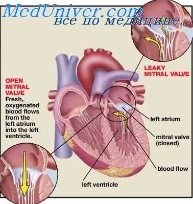 пролапс митрального клапана