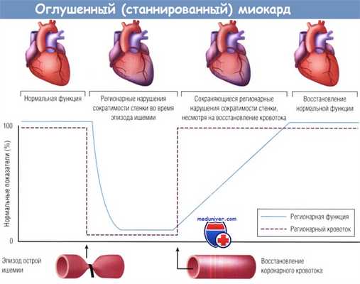 спящий миокард