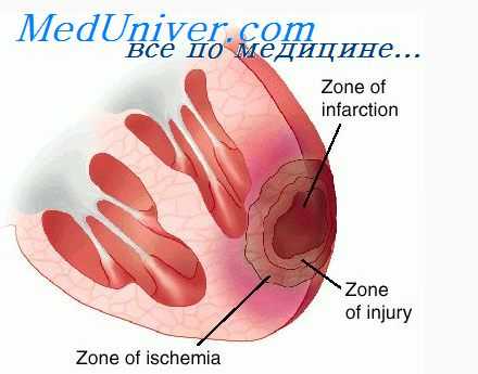 причины стенокардии