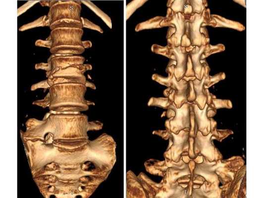КТ с 3D реконструкцией до операции: передняя и задняя проекции
