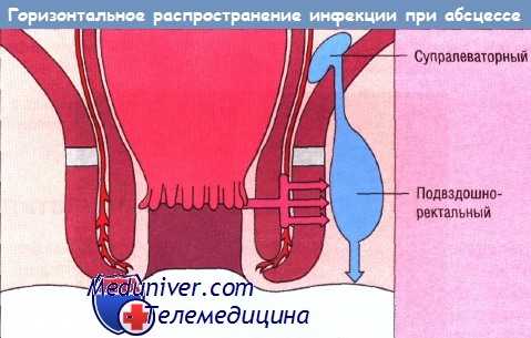 Горизонтальное распространение инфекции при абсцессе
