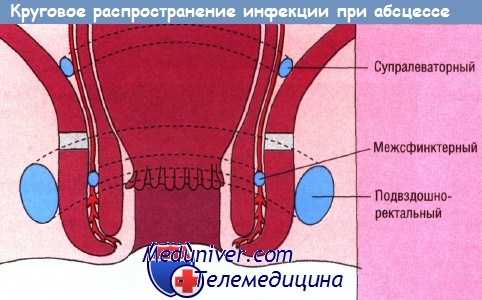 Круговое распространение инфекции при абсцессе