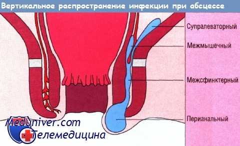 Вертикальное распространение инфекции при абсцессе