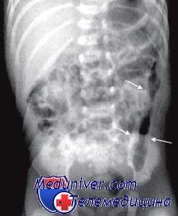 Толстокишечная непроходимость