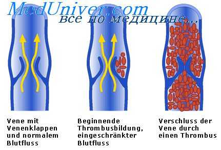 тромбоз артерий