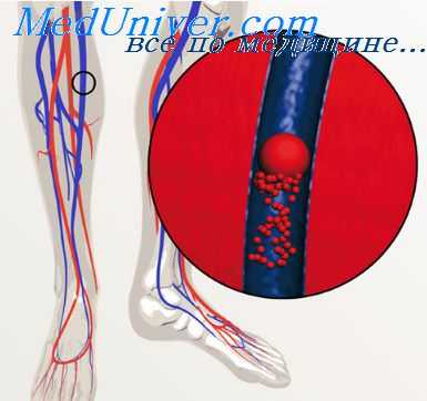 причины тромбозов