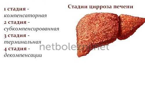 Стадии поражения печени
