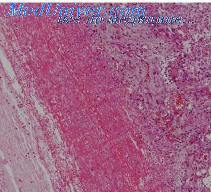 туберкулез пожилых