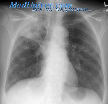 туберкулез взрослых