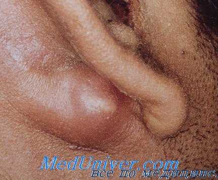 ушной менингит