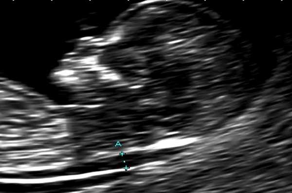 Рис. 1. Увеличение толщины воротникового пространства