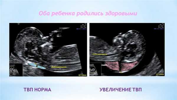 Увеличение ТВП