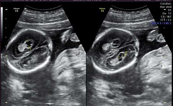 Кисты сосудистых сплетений (КСС)