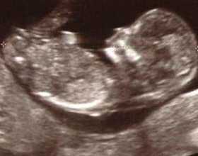 Расширение воротникового пространства у плода: причины последствия