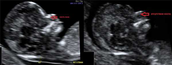 Гипоплазия, аплазия костей носа