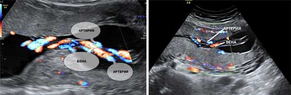 Единственная артерия пуповины