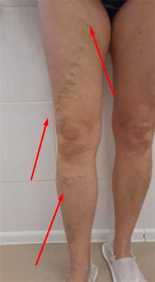 Варикоз в системе большой подкожной вены