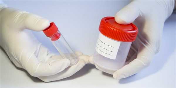 Зачем делают копрограмму? Цель процедуры и расшифровка результатов