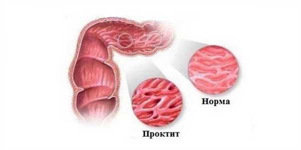 Проктит