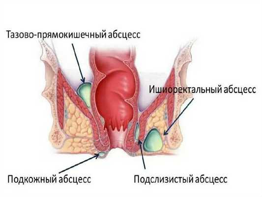 Анальный абсцесс
