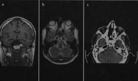Снимки МРТ и КТ. Пневматизация верхушки пирамиды височной кости