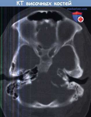 КТ височных костей с образованием в области верхушки пирамиды