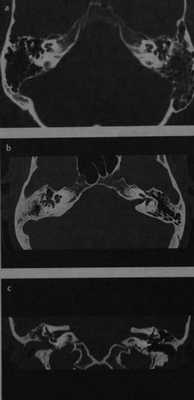 Снимки МРТ и КТ. Холестеатома пирамидки височной кости