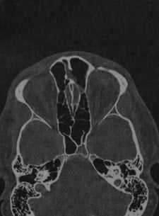 Снимки МРТ и КТ. Пневматизация верхушки пирамиды височной кости