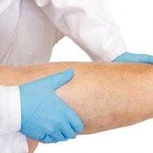 Лечение лимфостазов