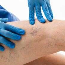 Варикозное расширение вен нижних конечностей