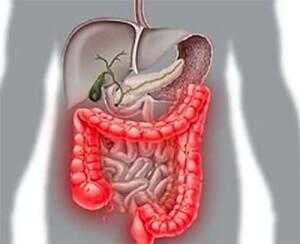 Воспаление кишечника