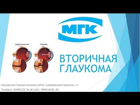 Видео Вторичная глаукома