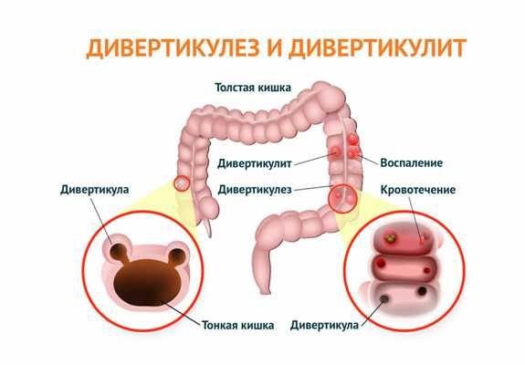 Дивертикулит и дивертикулез.jpg