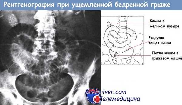 Рентгенография при ущемленной бедренной грыже