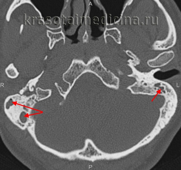 КТ височных костей. Тотальное снижение пневматизации ячеек сосцевидного отростка с обеих сторон. (фото Вишняков В.Н.)