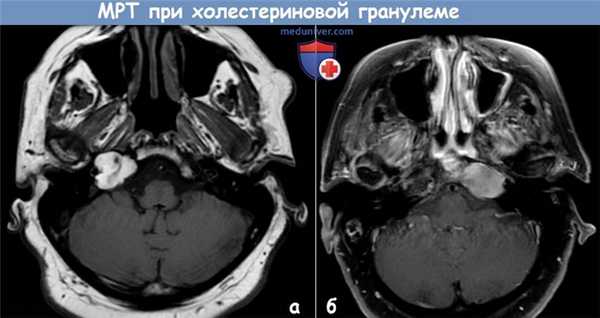 МРТ при холестериновой гранулеме