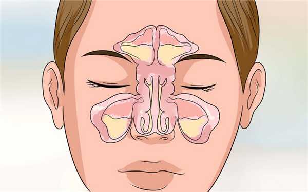Почему образуется хронический ринит и как его вылечить