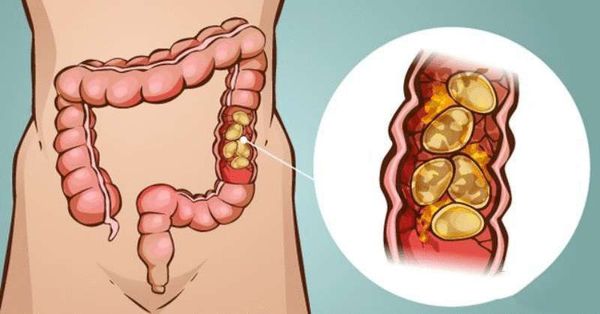 Каловые камни