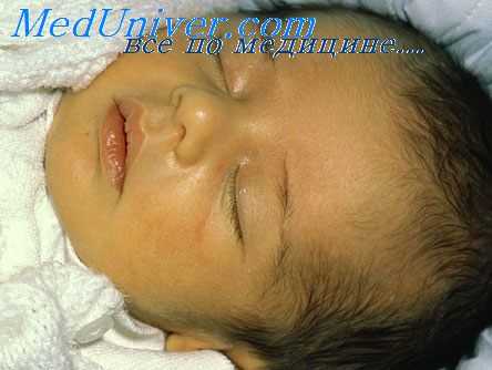 желтуха новорожденного