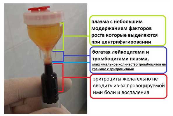 плазмалифтинг