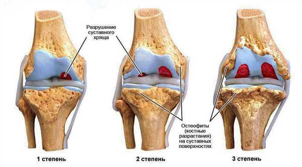 Степени развития артроза